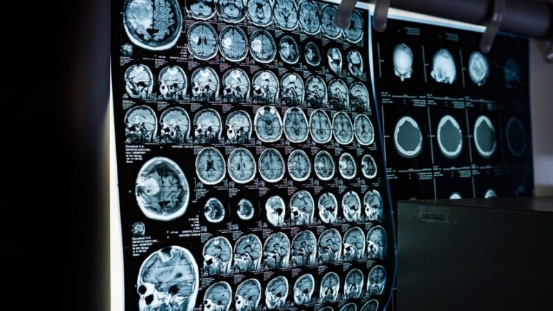 Objawy wczesne i rokowanie w przypadku guza mózgu